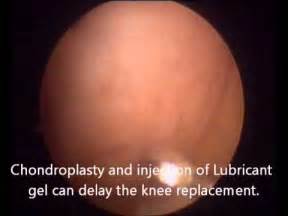 Chondroplasty-- Delay Knee Replacement Surgery - YouTube