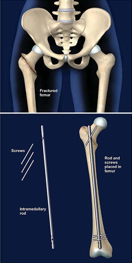 Fijación De Fractura De Fémur Con Vástago Intramedular | Grupo médico ...