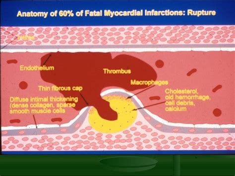 Atherosclerosis and its consequences (plaque rupture and