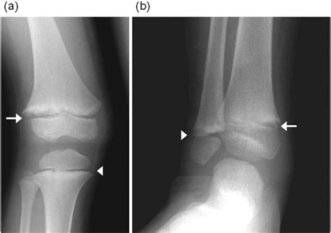 Rickets Disease X Rays