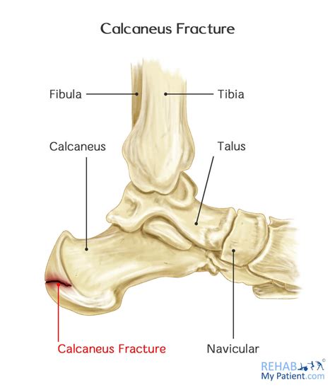 Calcaneus Fracture | Rehab My Patient