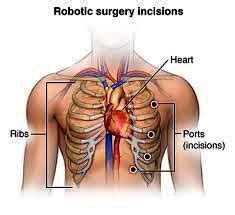 Affordable Robotic Cardiac Surgery Top Surgeons Best Hospitals India