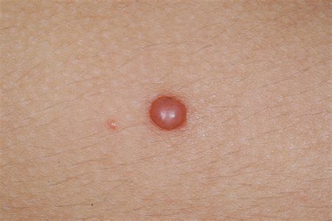 what is nevus - pictures, photos