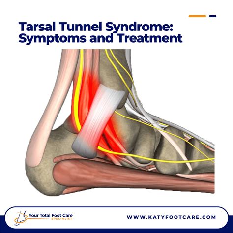 Tarsal Tunnel Syndrome: Symptoms and Treatment