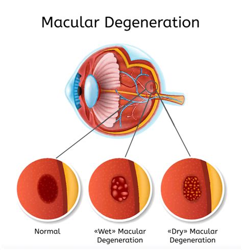 Macular Degeneration Treatment Stockton - Manteca CA