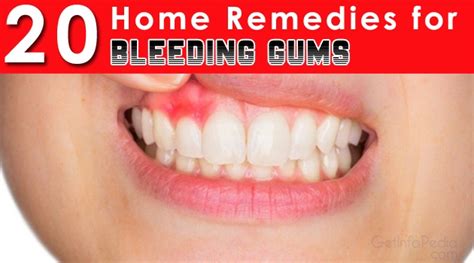 20 Home Remedies For Bleeding Gums - Getinfopedia.com