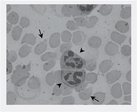 Peripheral blood smear: The arrows indicate the macro-ovalocytes with... | Download Scientific ...