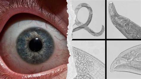 Itchy? These Worms Are Suddenly Breeding in People's Eyes and Scientists Are Baffled - Weird ...