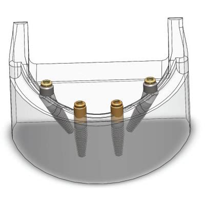 Zest Anchors LOCATOR for Implant Procedure | Zest Dental Solutions