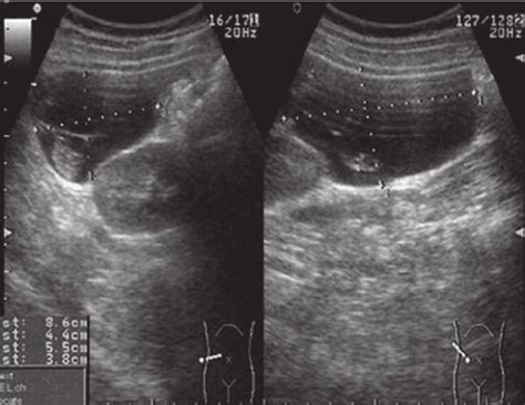 Liver ultrasound in Case 3 revealed a large cyst (8.5/4.5 cm) with thin ...