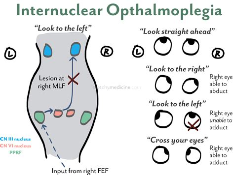 Internuclear Opthalmoplegia | Sketchy Medicine