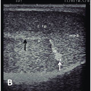 Ultrasound image of pampiniform plexus. (A) Right pampiniform plexus... | Download Scientific ...