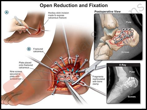 life after a calcaneus fracture surgery - Pearle Payton