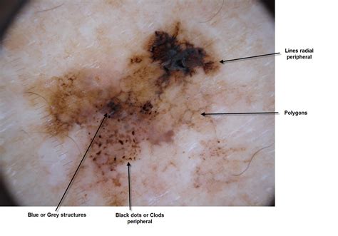 Dermoscopy Made Simple: Clues to Melanoma