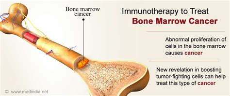 Bone Marrow Cancer: New Insights into Boosting Tumor-Fighting Cells