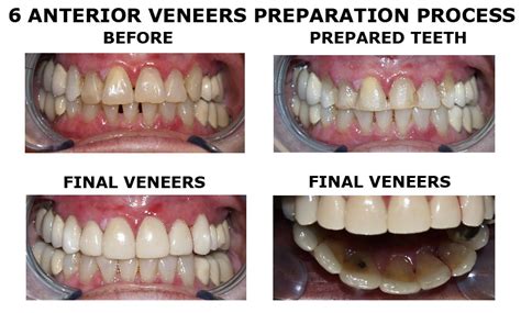 Porcelain Veneers | My Family Dentist