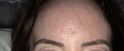 Forehead acne scars - Scar treatments - Acne.org