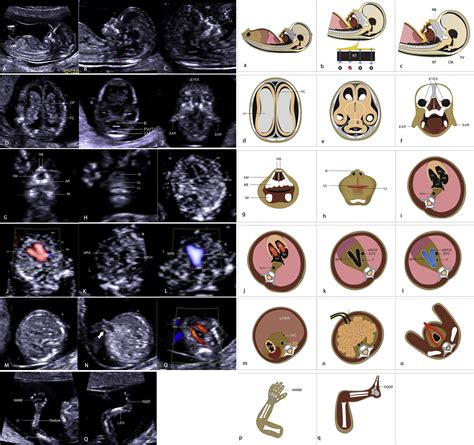 Routine first-trimester ultrasound screening using a standardized anatomical protocol - American ...