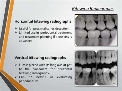 Radiographic aids in dx of periodontol ds