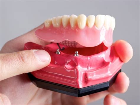 Removable Implant Overdentures | Snap-In Dentures | Ottawa