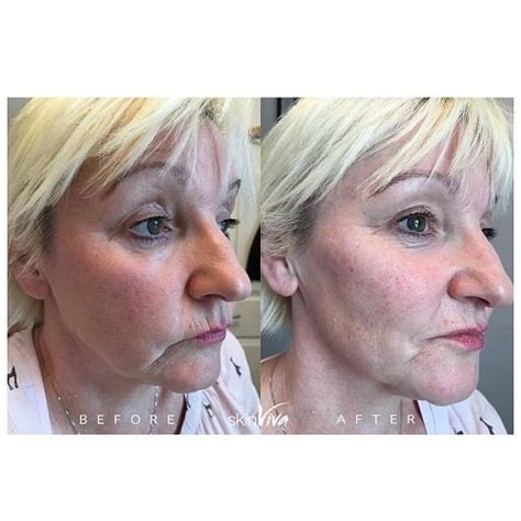 Jowls and Jawline, BOTOX® and Fillers | SkinViva Manchester