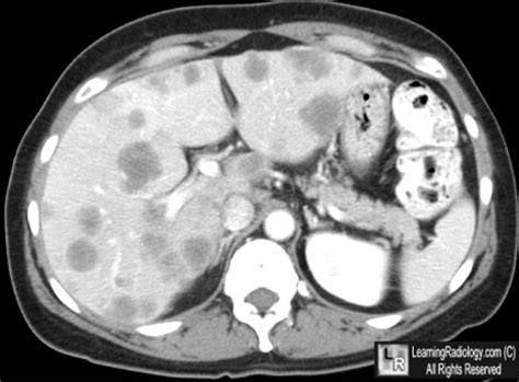 LearningRadiology - Liver Metastases, Hepatic, Mets