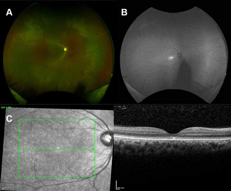 Achromatopsia: for professionals - Gene Vision