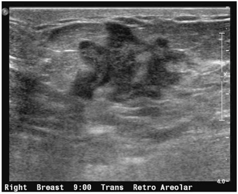 Focused ultrasound of the right breast in the retroareo | Open-i