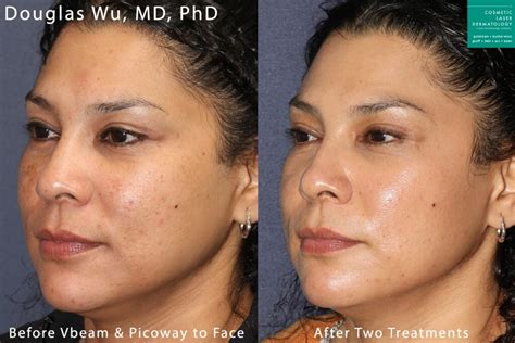 Picoway Laser Skin Treatment | San Diego, CA | CLDerm