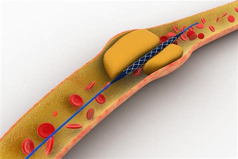 Coronary Stent Placement - LAS VEGAS CARDIOLOGY