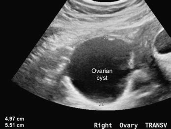 First Trimester Ultrasound | Basicmedical Key