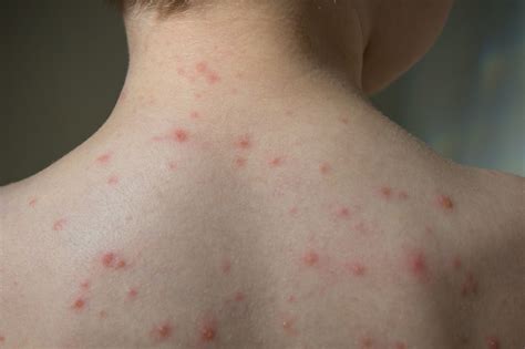 Varicella Rash After Vaccine