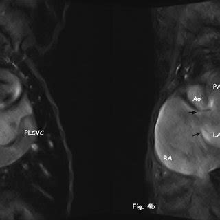 Magnetic resonance imaging (MRI) double oblique image plane, (cardiac ...