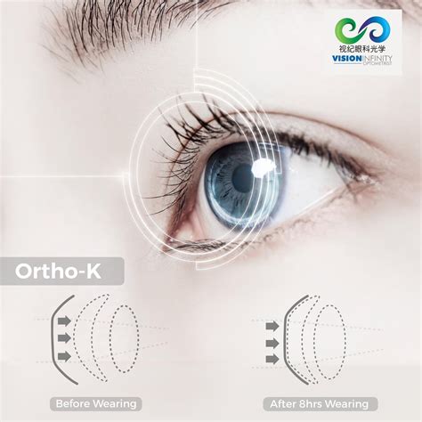 What is Orthokeratology (Ortho-K)? | Vision Infinity Optometrist