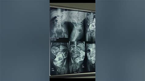 XRAY | Barium Enema | Hirschsprung Disease | Megacolon | Intestinal Obstruction | Ultrasound ...