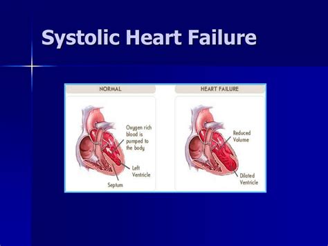 PPT - Systolic and Diastolic Heart Failure PowerPoint Presentation, free download - ID:1410892