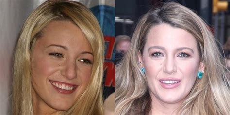 Blake Lively's Nose Job Surgery: Face Before and After