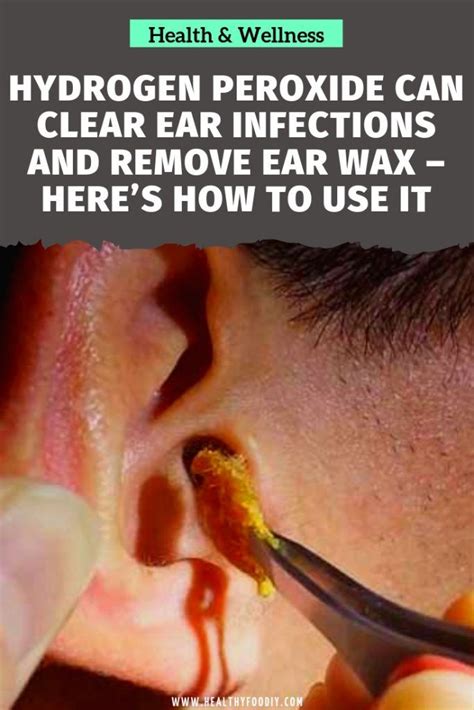 Hydrogen Peroxide Can Clear Ear Infections and Remove Ear Wax – Here’s How to Use it | Health ...