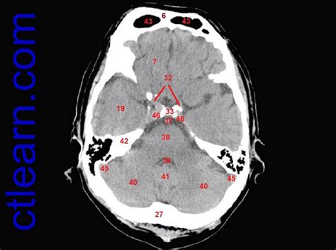 Anatomy CT Axial Brain