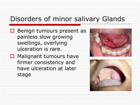 PPT - Salivary Glands Disorders PowerPoint Presentation, free download ...