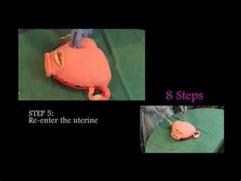 How to perform B-Lynch Suture? - YouTube