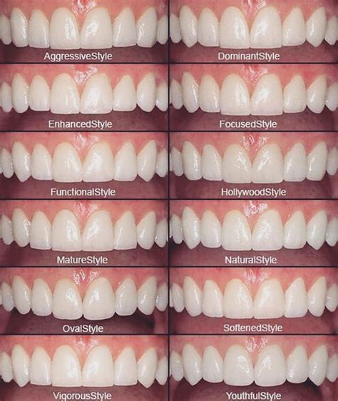 Shape of your teeth speak about your personality | Dental cosmetics, Dental veneers, Cosmetic teeth