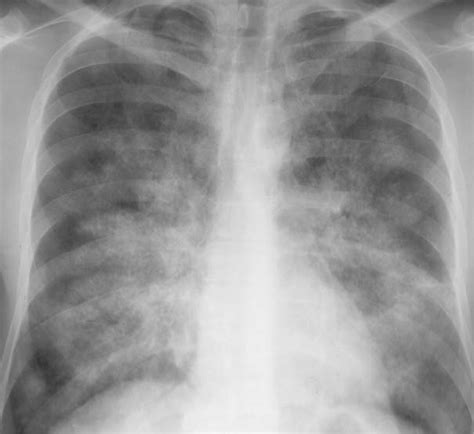 Pulmonary Edema and Symmetrical Bilateral Infiltrates | Radiology Key