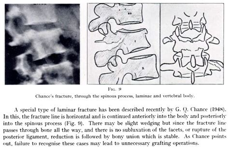 Chance fracture • LITFL Medical Blog • Medical Eponym Library