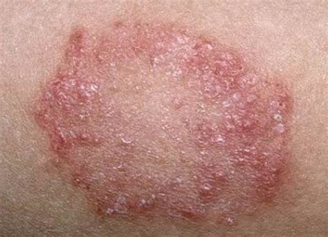 Skin disease or Eczema- Eczema—Also known as atopic dermatitis, this is a long-term skin disease ...