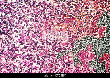 SEMINOMA, HISTOLOGY Stock Photo - Alamy