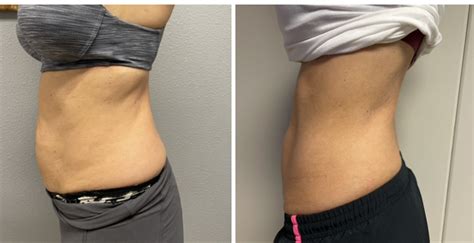 EXILIS SKIN TIGHTENING - Aesthetics & Medical Lasers of Colorado