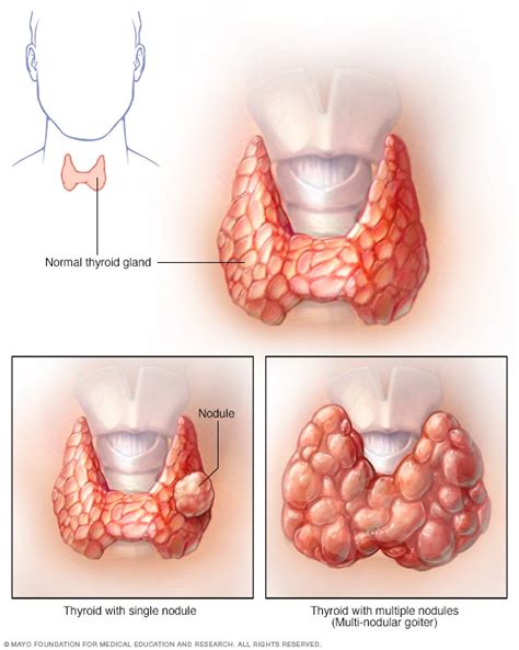 Thyroid nodules - Symptoms and causes - Mayo Clinic