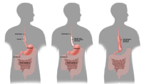 Surgical Procedures for Primary GIST | GIST Support International