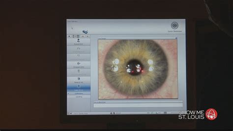 TLC Vision: Lasik surgery | ksdk.com